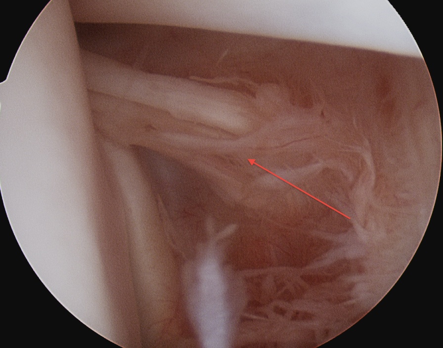 Superior Glenohumeral Ligament